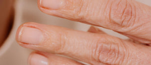 Nagelwall pflegen, Entzündung Nagelwall und Behandlung