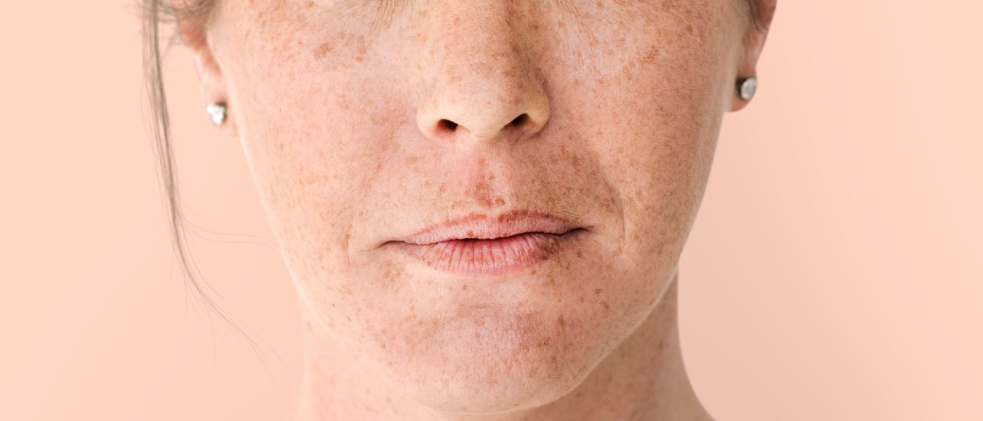 Unreine Haut im Gesicht, unreine Gesichtshaut